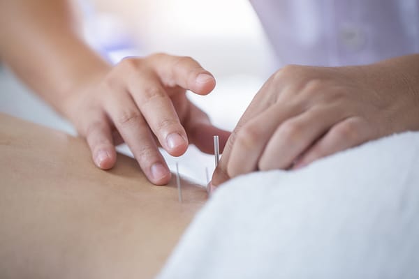 Traditional Chinese Medicine Treatment - Acupuncture - 밴쿠버 한의원